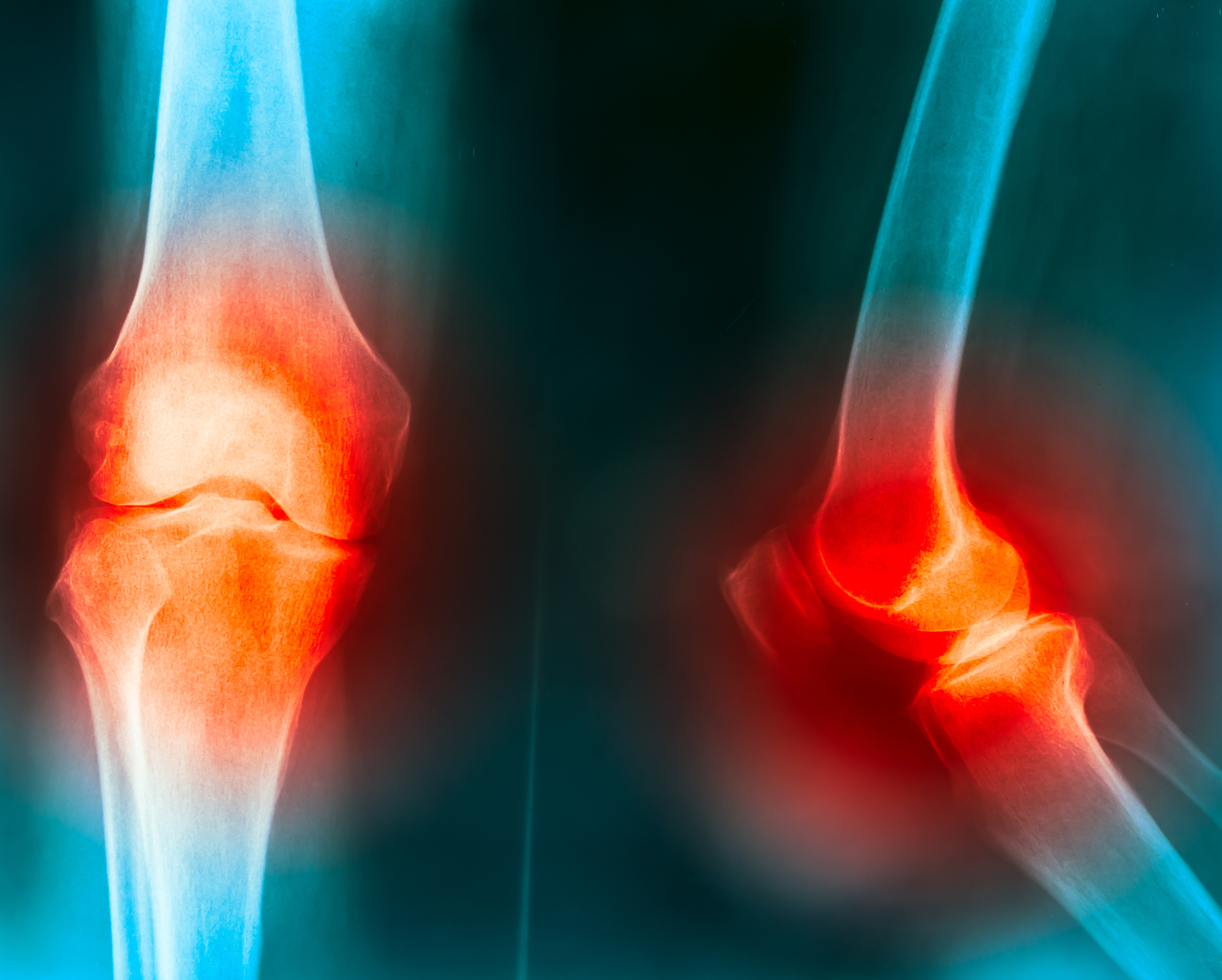 Thumbnail for New study shows zoledronic acid is not effective for knee osteoarthritis